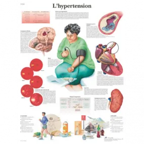 Planche anatomique sur l'hypertension 3bs Scientific